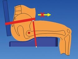 Figura 3. Posicionamiento del cinturón de 4 puntos para controlar la inclinación pélvica anterior.